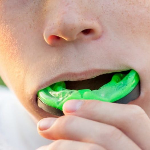 What Are Types of Mouth Guards?