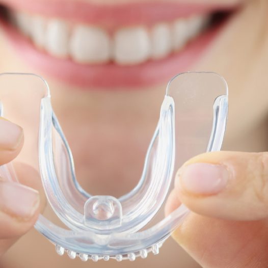 A Comparison Guide between Mouth Guards Vs. Retainers