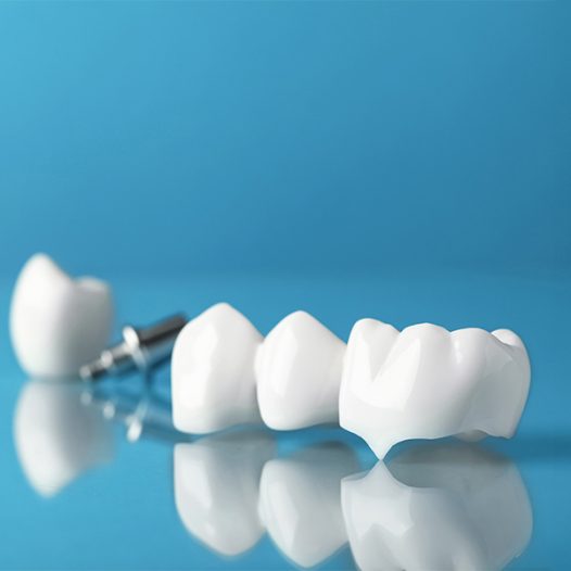 When To Replace a Crown After a Root Canal in Houston